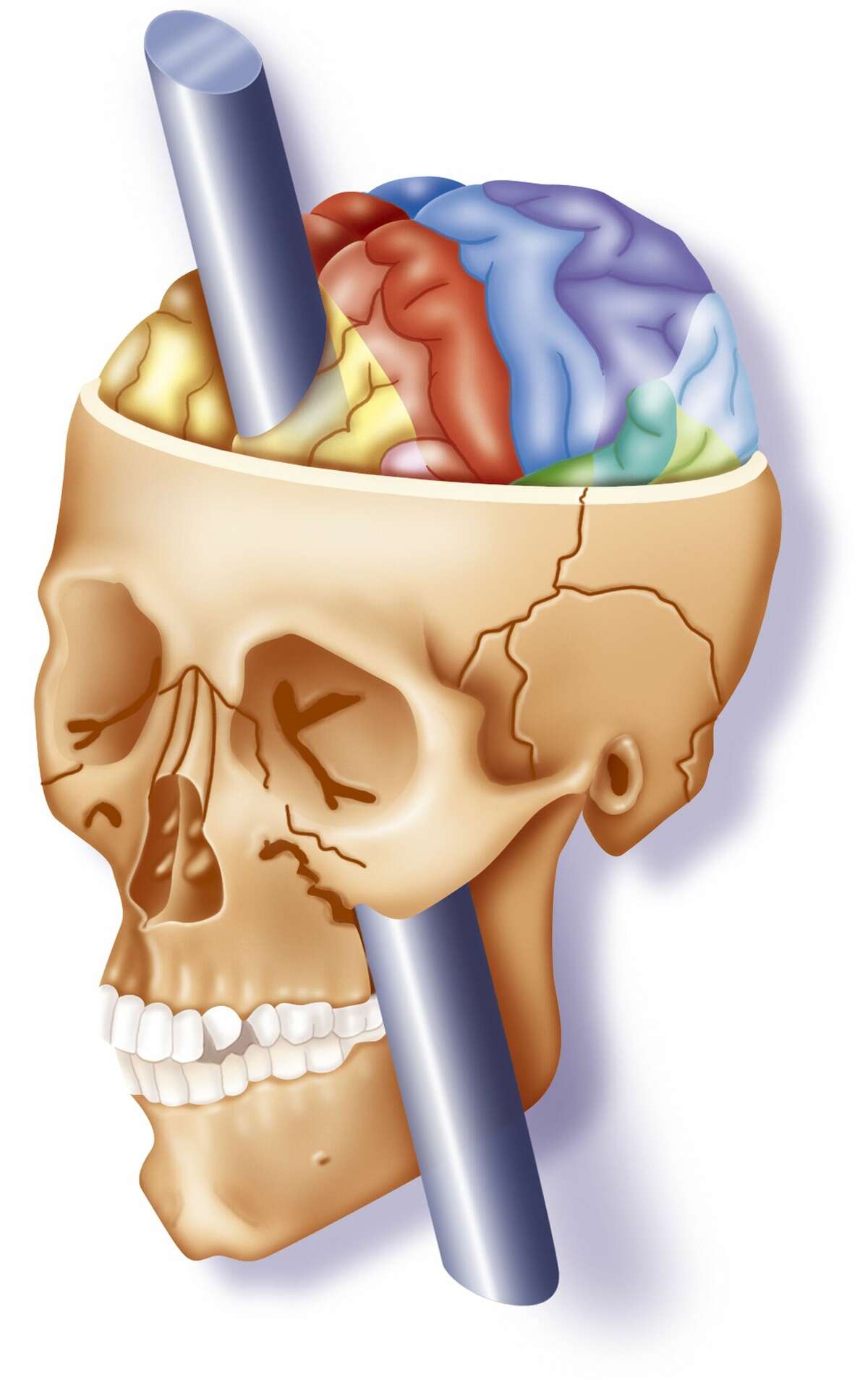 Una ilustración que muestra el daño en el lóbulo frontal de Phineas Gage cuando una barra de hierro atravesó su cráneo. 
