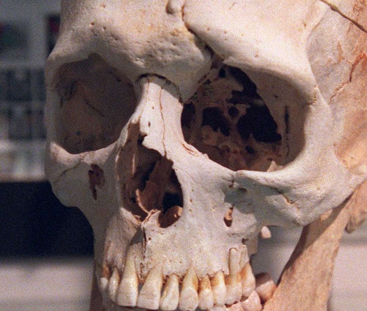El cráneo de Phineas Gage en exhibición en el Museo Anatómico Warren en la Biblioteca de Medicina Countway en la Escuela de Medicina de Harvard. 
